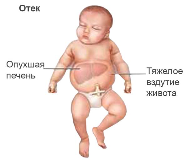 Реферат: Гемолитическая болезнь новорожденных 2