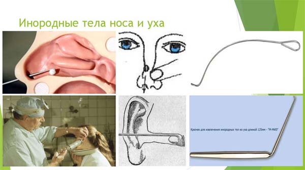 https://natural-museum.ru/sites/default/files/inline-images/Инородное тело носа уха горла.jpg