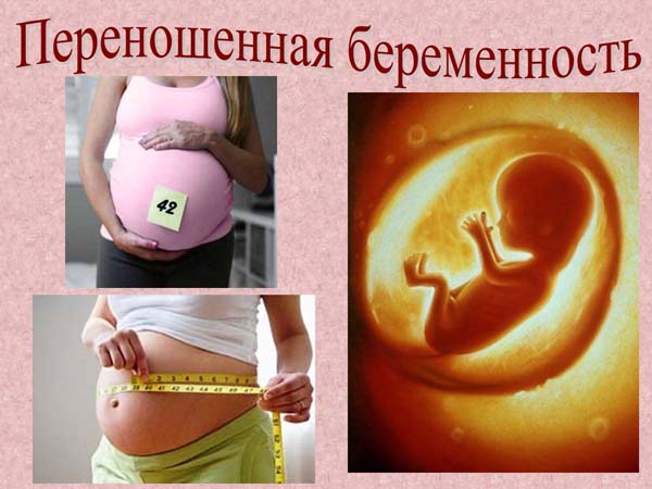 Переношенная беременность