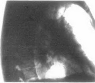 Рентгенограмма органов грудной клетки в правой боковой проекции