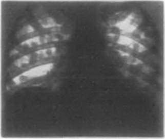 Рентгенограмма органов грудной клетки в прямой проекции