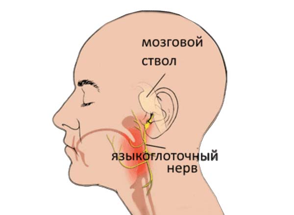 Сикара синдром