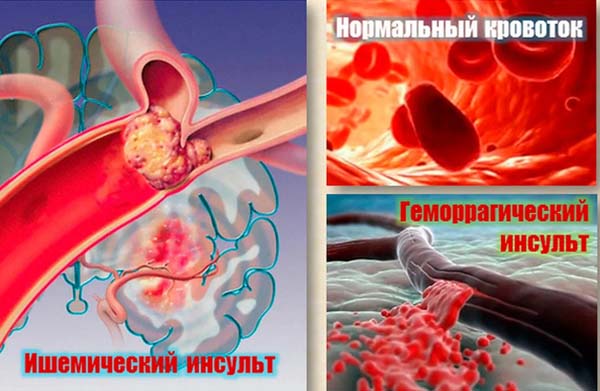 Инсульт после замены клапана