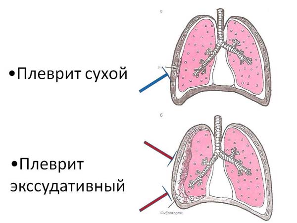 Гнойный плеврит картинки